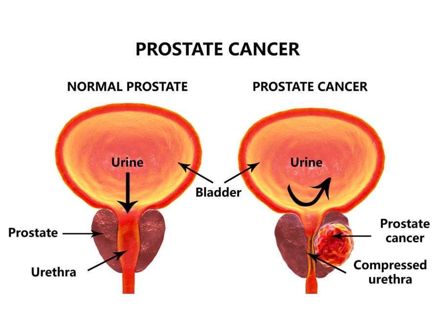 normal prostate vs prostate cancer prostate massage Singapore, Prostate Massage Therapy, male reproductive health, prostate cancer